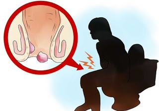 Obat ambeien utk ibu hamil, jual obat wasir di martapura, mengobati penyakit wasir bagi ibu hamil, obat untuk mengobati wasir yang bagus apa ya, cara penyembuhan ambeien atau wasir/ambeien, khasiat bawang putih obat untuk penyakit wasir, apakah ambeyen penyakit turunan, jual obat wasir di kalimantan, obat buat penyakit wasir tradisional ibu hamil, obat wasir di manado (menado), cara menyembuhkan wasir parah secara alami